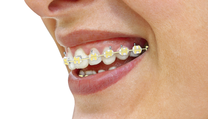 smile with color band on braces
